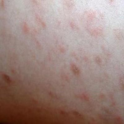 郑州引起的儿童牛皮癣会有哪些症状