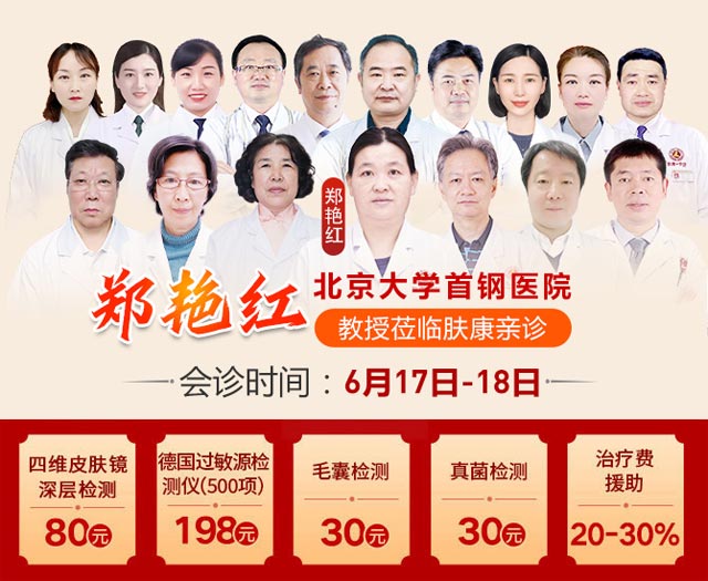 通知:6月17至18两天郑州肤康特邀郑艳红教授联合会诊